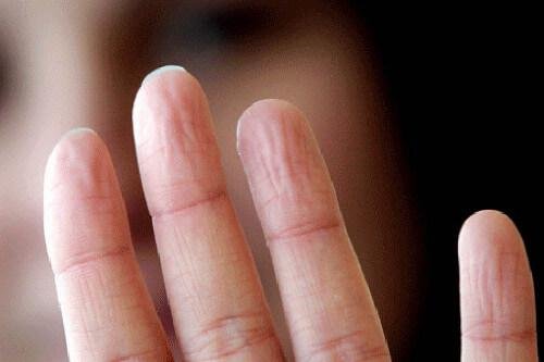Здравословни проблеми:пръсти на ръка 