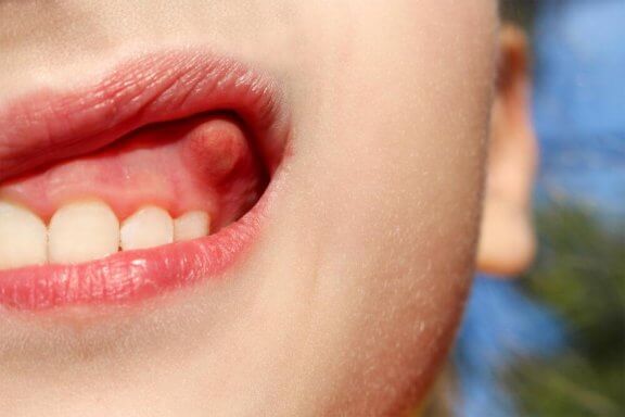 Как да излекувате абсцеса на зъба с 10 домашни средства