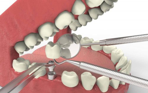 Импланти при зъбна агенезия