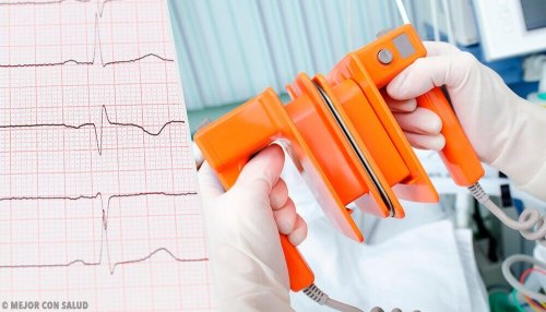 Причини за появата на предсърдното мъждене