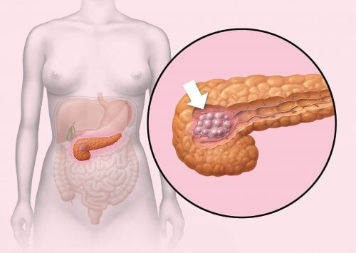 Симптоми на рак на панкреаса