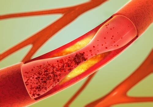 Запушването на артерии може сериозно да застраши здравето ви.