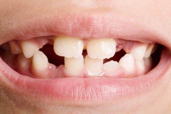 Зъбна агенезия: видове и лечение