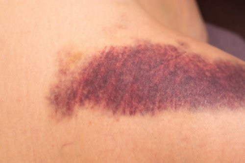 Недостиг на витамин К: червени петна