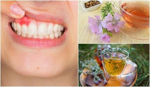 5 натурални домашни средства срещу гингивит