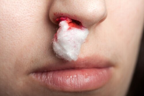 Витамин К: кръвотечение от носа