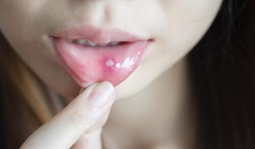 Как да лекувате язвите и афтите в устата