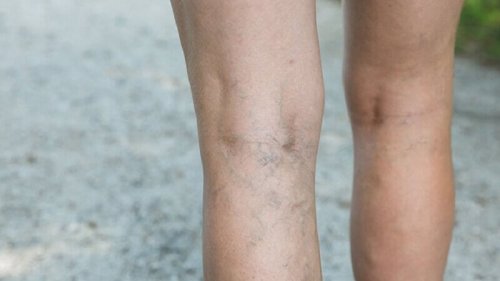 За да избегнете разширените вени: снимка на долната част на краката на жена, с разширени вени.