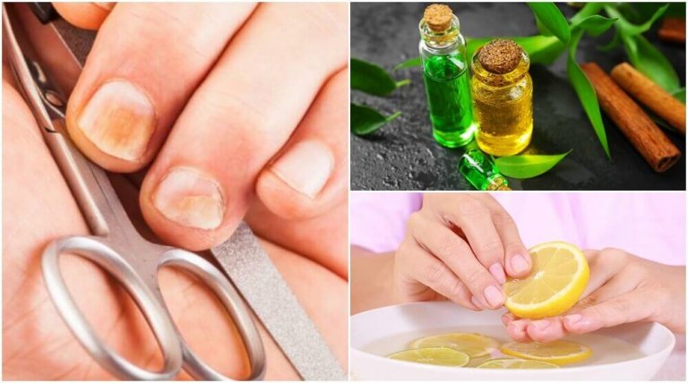 5 трика за премахване на гъбичките и укрепване на ноктите