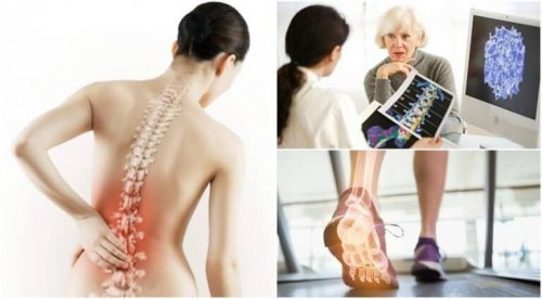 остеопороза, колаж от три снимки