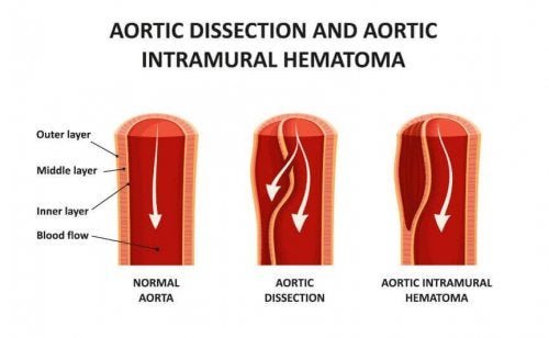Разксъването на аортата може да отнеме човешки живот.