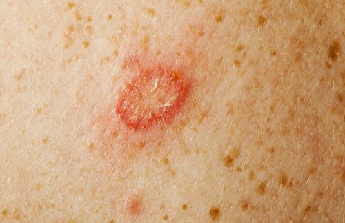 Кожните гъбични инфекции: снимка на възпалена кожа