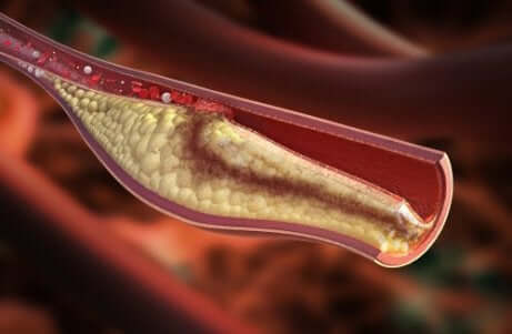 Снимка на кръвоносен съд с холестерол