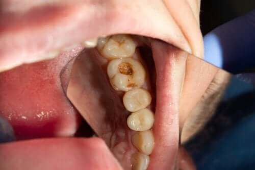 Зъбните кариеси: кои са причините за дупките в зъбите?