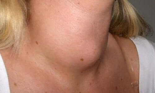 Една бучка на шията най-често се дължи на скорошна инфекция.
