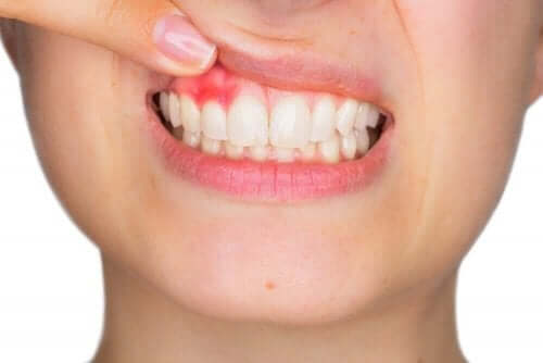 Заболяване на зъбните венци
