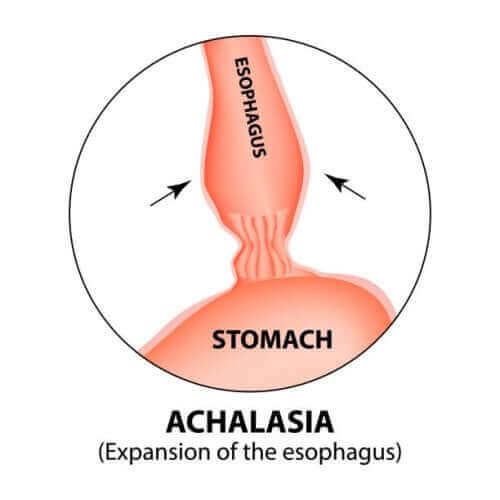 Ахалазия на хранопровода: диаграма