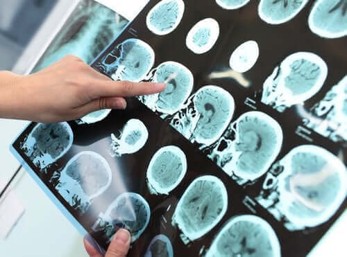 Основно неврокогнитивно разстройство (Деменция): същност и лечение