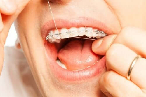 Почистване на зъбите с конци при носене на ортодонтски апарати.