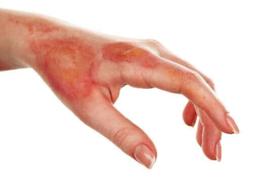 Повърхностно изгаряне: снимка на изгоряна ръка