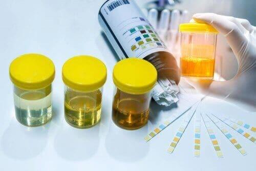 Наличието на нитрити в урината говори за инфекция.