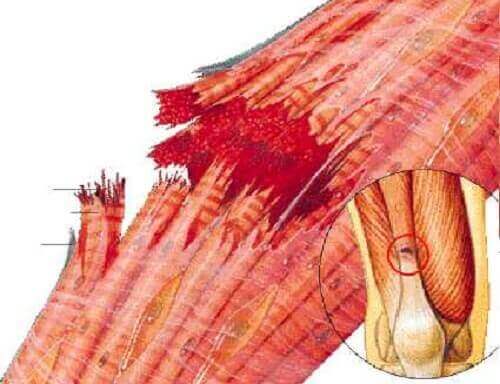 Мускулното разтягане: рисунка на мускул и скъсани мускулни влакна