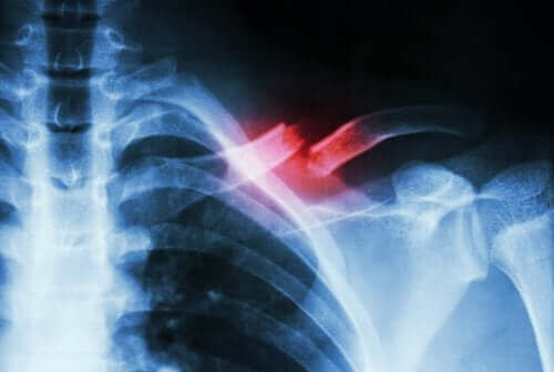 Стресова фрактура: рентгенова снимка на стресова фрактура на рамо