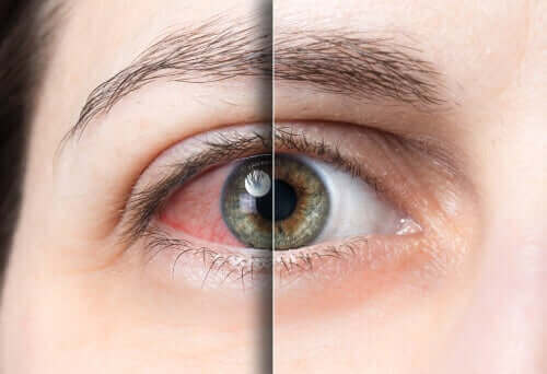 Конюнктивитът: зачервено око на жена