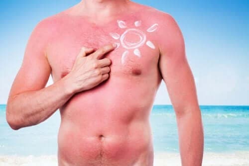 Вредните ефекти на слънцето: мъж със слънчево изгаряне