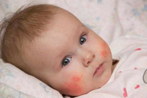 Атопичният дерматит при бебетата: снимка на бебе с дерматит по лицето