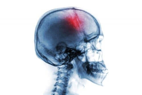 Мозъчният удар: схема на череп