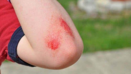 Редица натурални средства спомагат предотвратяване възпалението на кожата.