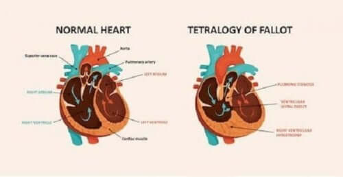 Вродената сърдечна болест: диаграма на здраво и на болно сърце