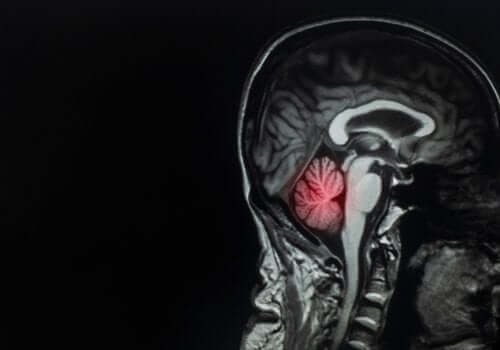 Метастазите на мозъка: Описание и лечение