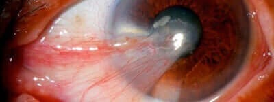 Птеригиум: снимка на око с това заболяване