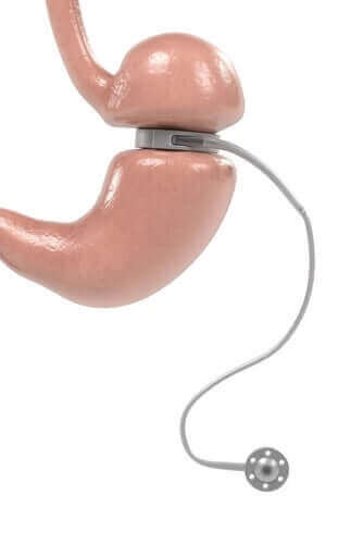 Регулируемият стомашен пръстен – приложение и характеристики