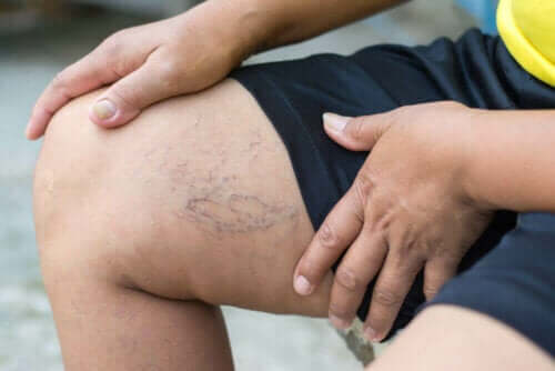 разширени вени