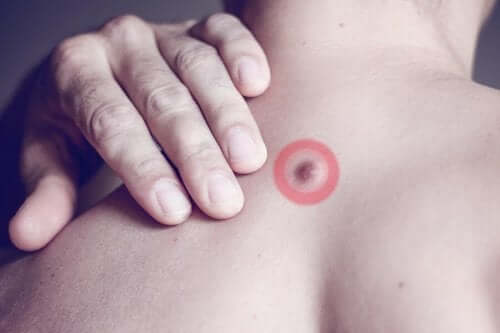 Причините за мастните бучки по гърба