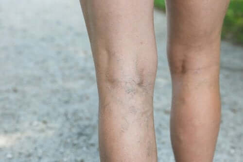 Натурално лечение на варикозните вени: разширени вени от вътрешната страна на краката