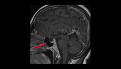 Рентгенова снимка на кост