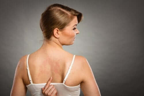 Хранителни добавки: жена с обрив на гърба