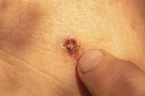 Какво да правите когато кървят брадавиците.