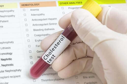 Висок холестерол се установява чрез кръвен тест