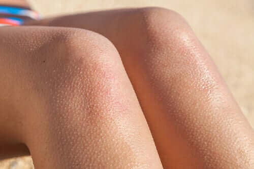 Пилоерекция: настръхване на кожата на краката