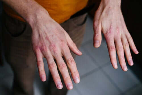 Сухи и напукани ръце: Предпазване от студа