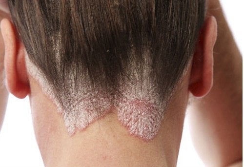 Най-добрите средства за лечение на трихофития на скалпа