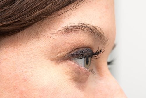 Тъмни кръгове под очите ви: причини и естествено лечение