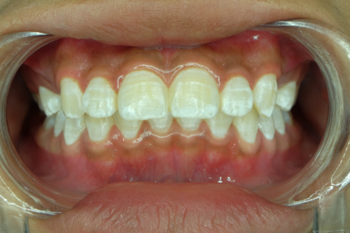 Белите петна по зъбите: защо се появяват?