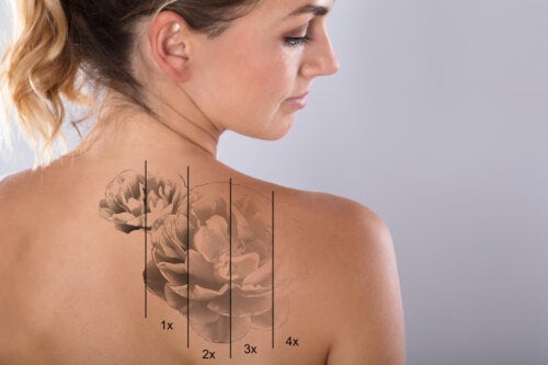 Какви са рисковете от лазерно премахване на татуировки?