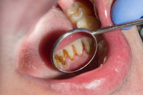 Защо зъбният камък почернява? Лечение и превенция